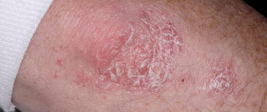 Close-up of plaque psoriasis (Psoriasis vulgaris) on an elbow.