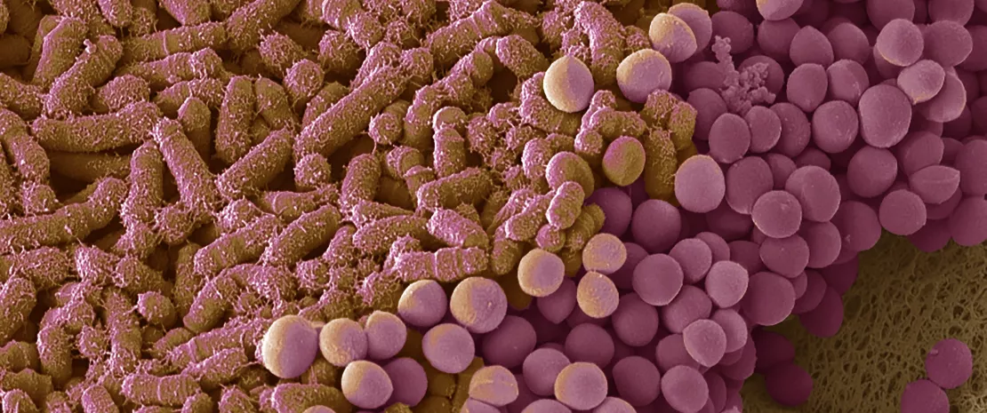 Photo: Fecal microbiota: a biomarker for colorectal cancer and its progression