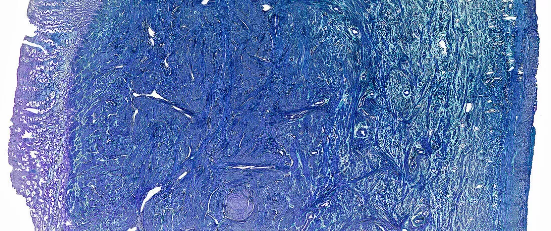 Photo: Endométriose : la piste de l’immunité ouvre de  nouvelles voies de traitement