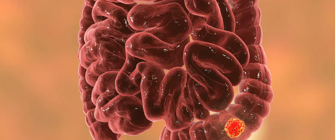 Intratumoral microbiota in colorectal cancer: an independent prognostic indicator? 