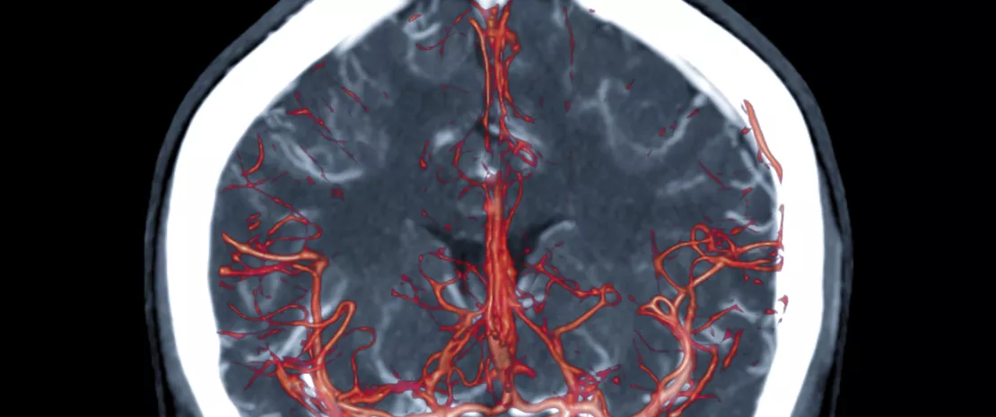 Photo : Is the gut microbiota a major risk factor for intracranial aneurysm?