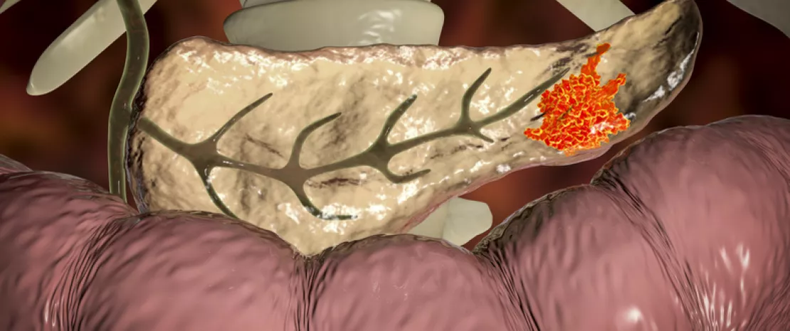 Actu PRO : Cancer du pancréas : le rôle majeur des bactéries de la tumeur