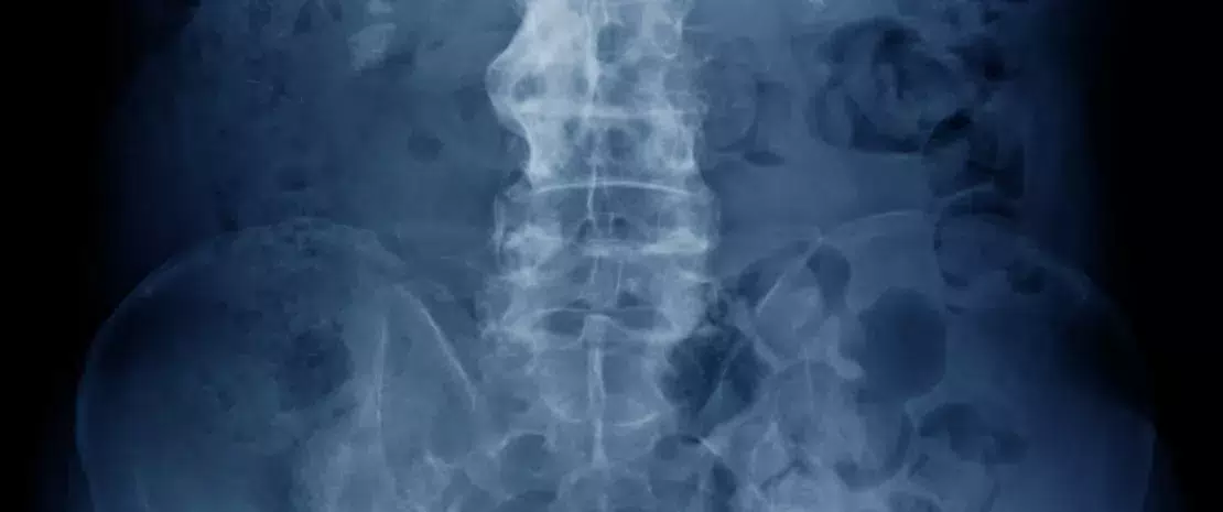 Photo : Ankylosing spondylitis: the role of fungal microbiota