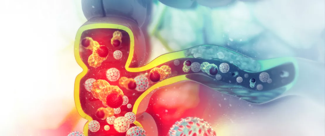 Photo : Colorectal cancer: from dysbiosis to DNA alteration