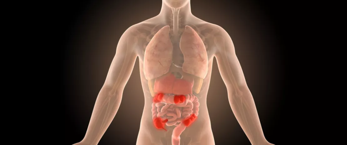 Photo : Gut microbiota as a predictor of recurrence of Crohn’s disease