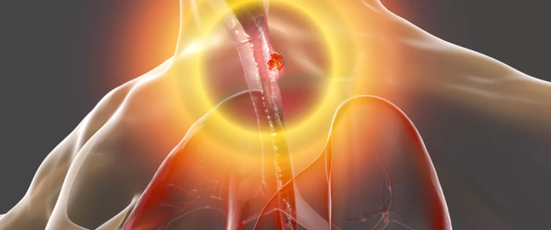 Photo : F. nucleatum: prognostic marker for esophageal cancer?