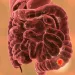 Intratumoral microbiota in colorectal cancer: an independent prognostic indicator? 