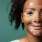 Photo: How your gut microbes drive vitiligo's white patches