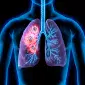 Actu PRO : Cancer du poumon : le microbiote intestinal signerait un stade précoce