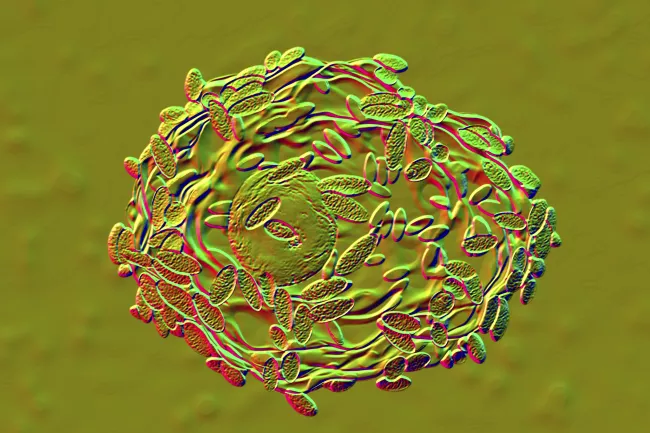 Bacterial vaginosis. Illustration of Gardnerella vaginalis bacteria (rods) attached to epithelial cells, known as clue cells.