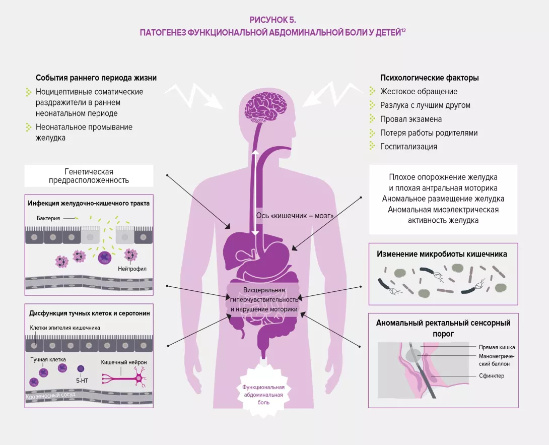 FGIDS-In-children-RU-infography